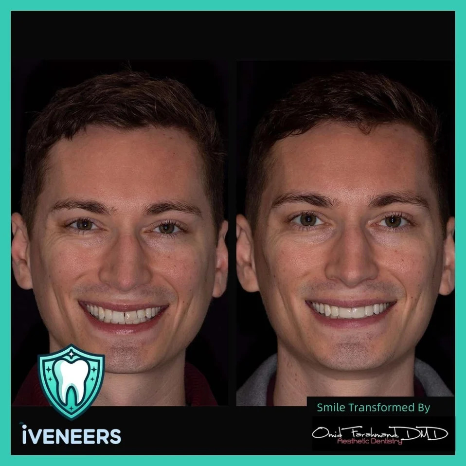 Unveiling the Financial Facet of Smile Transformation: A Closer Look at Porcelain Veneers Cost